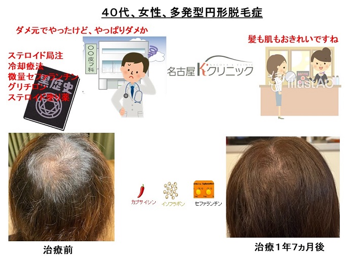 円形脱毛症　病院